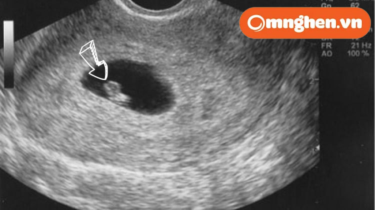 Hình ảnh siêu âm của thai 5 tuần tuổi.